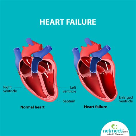 what is lv dysfunction|is left ventricular hypokinesis dangerous.